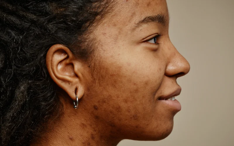 OLIVER DENTAL Y MED SPA Tratamientos para manchas en la piel